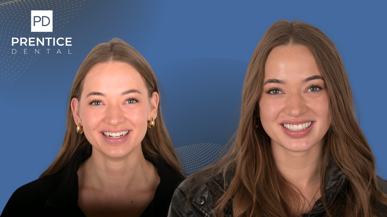 Smile transformation before and after treatment